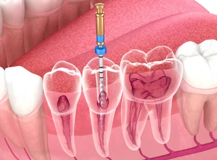 Endodontie : traitement des racines à Vienne